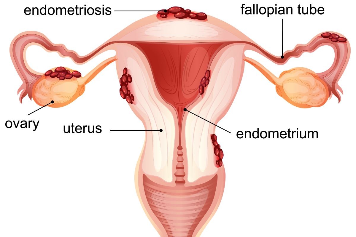 Endometriosis