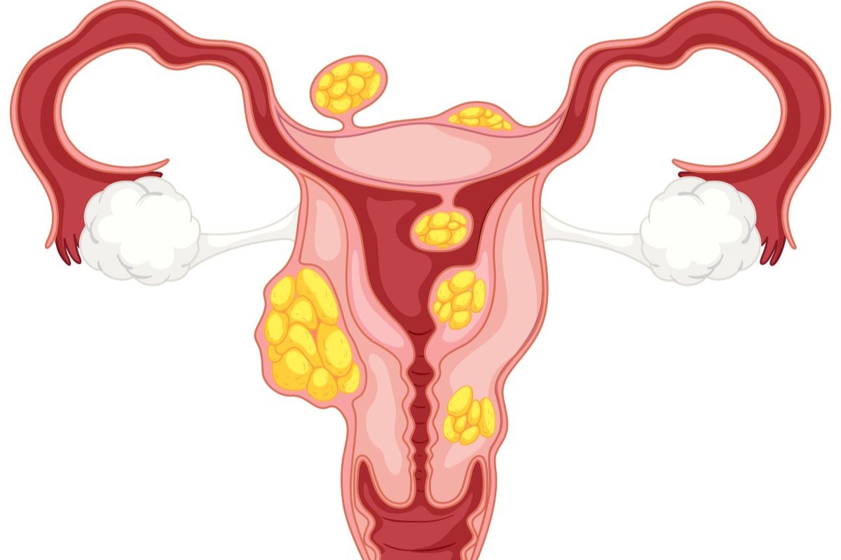 Uterine Fibroids